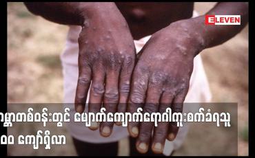 Embedded thumbnail for ကမ္ဘာတစ်ဝန်းတွင် မျောက်ကျောက်ရောဂါကူးစက်ခံရသူ ၂၀၀ ကျော်ရှိလာ