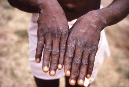 A monkeypox patient in the Democratic Republic of the Congo during an outbreak in 1997. PHOTO: CDC/ BRIAN W.J. MAHY